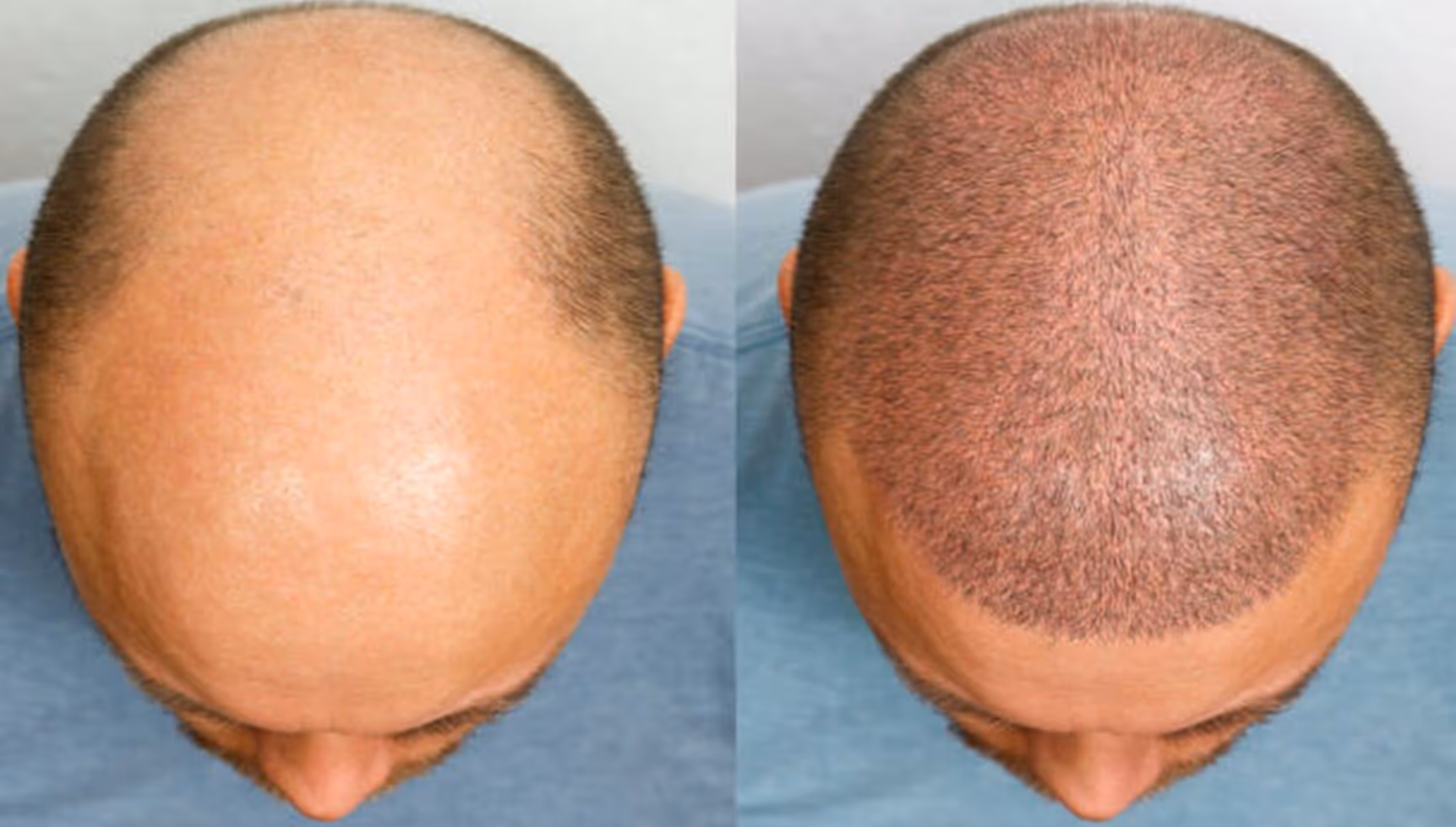 hair transplant before and after