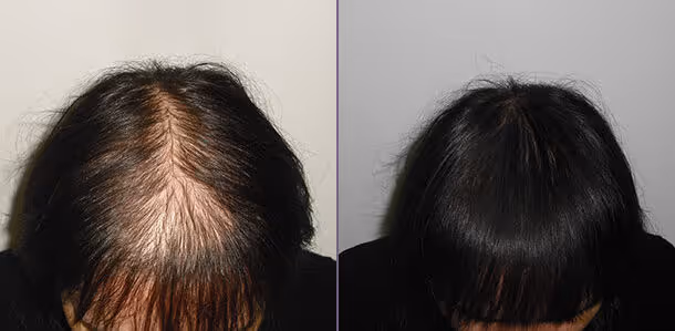 hair transplant before and after