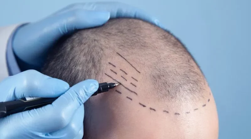 hair transplant treatment