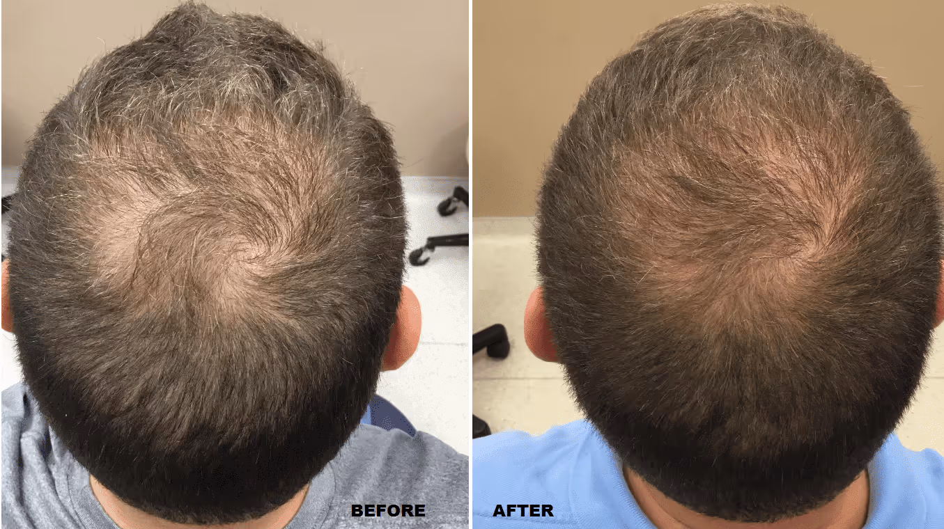 hair transplant before and after