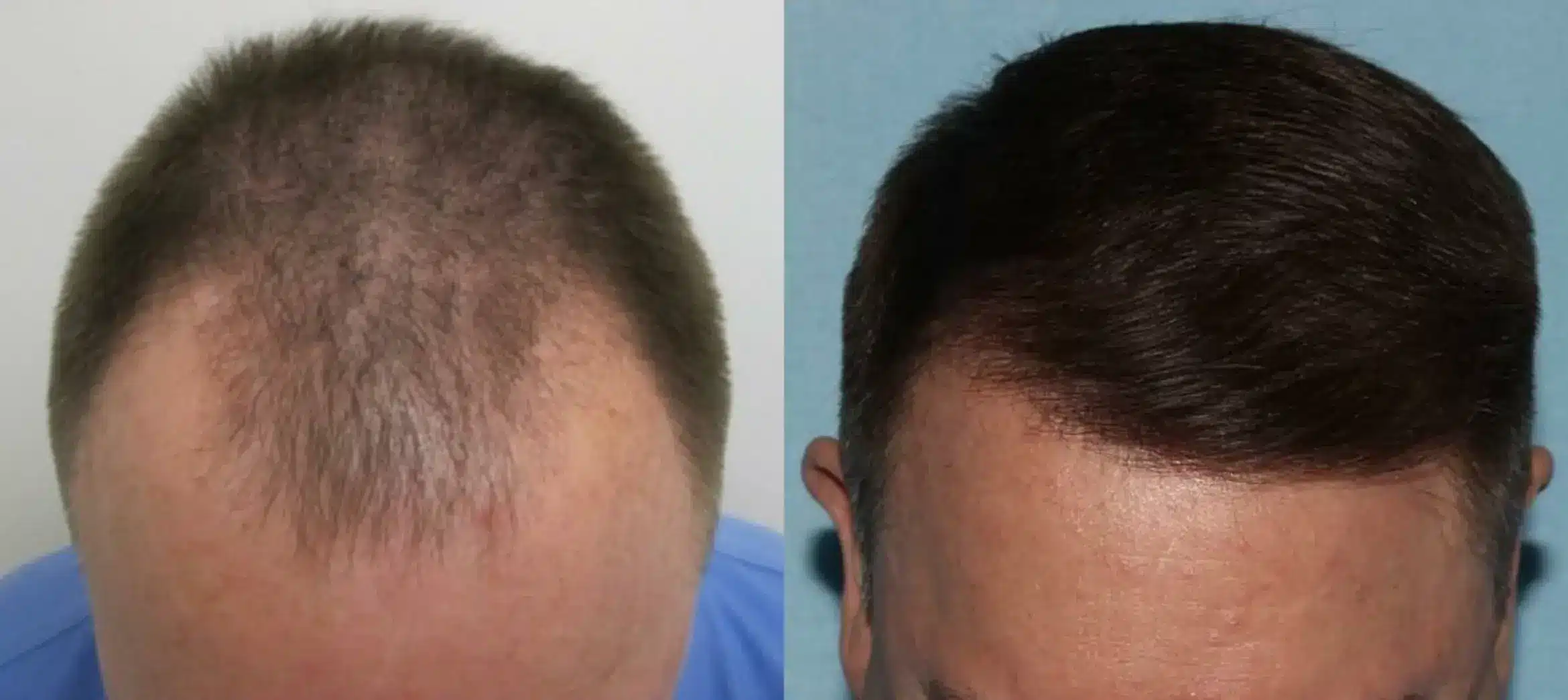 hair transplant before and after