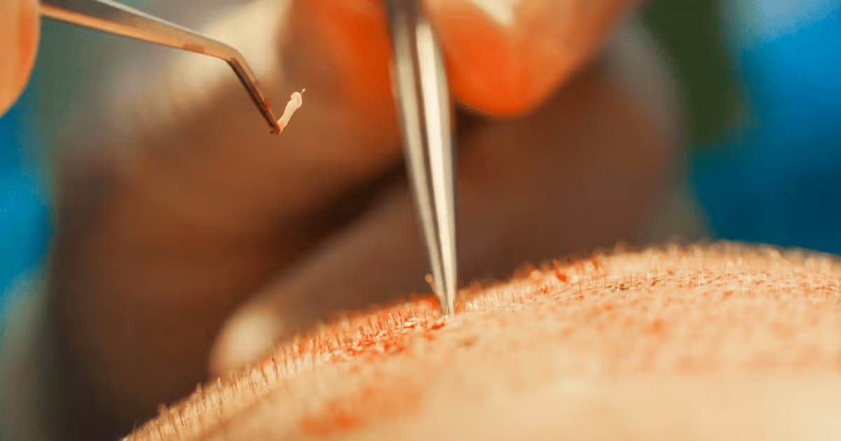 hair transplant