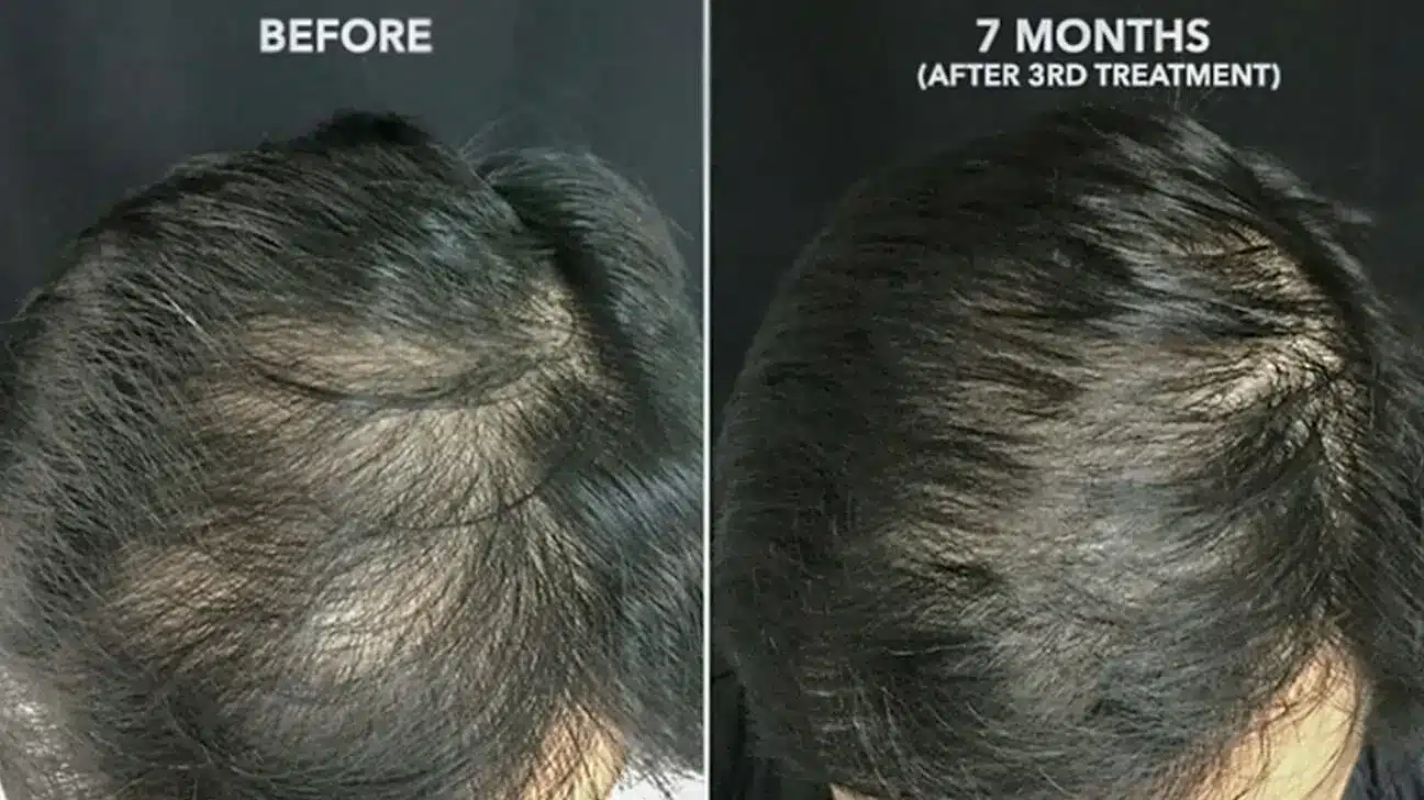 prp hair restoration before and after