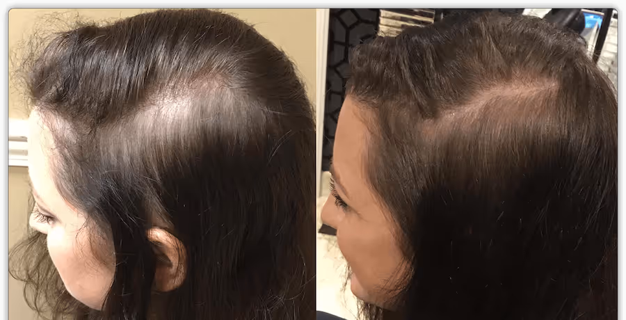 prp hair restoration before and after