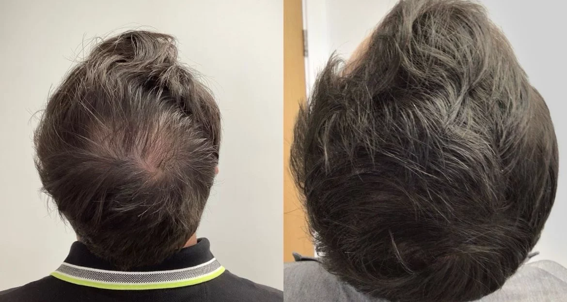 prp hair restoration before and after