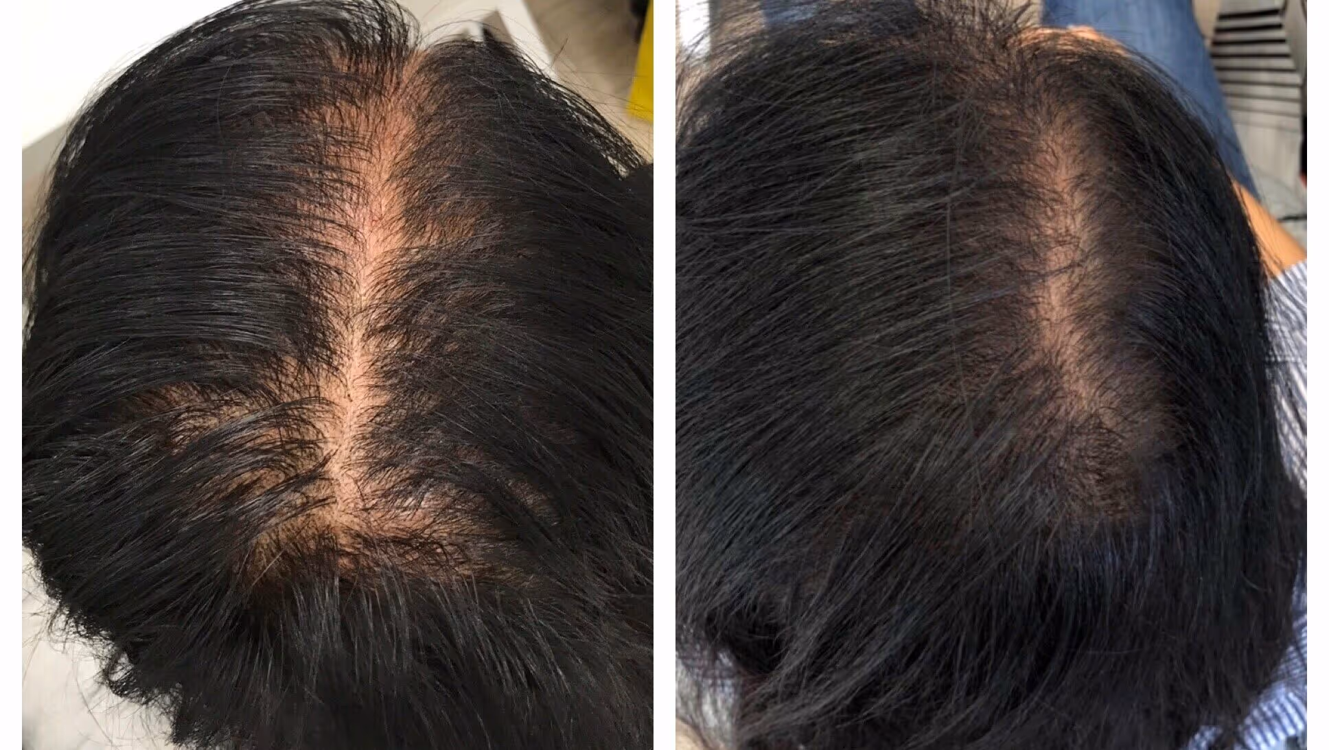 prp hair treatment richmond hill