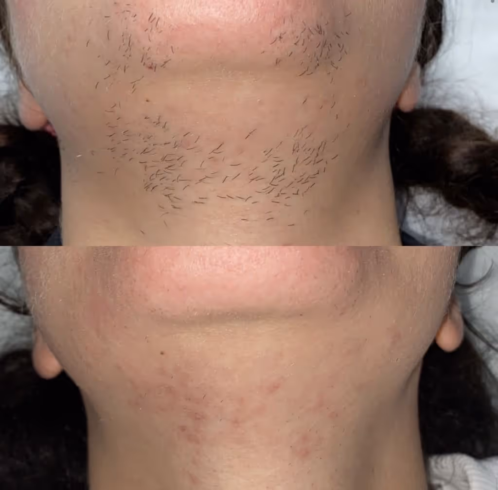 pcos laser hair removal