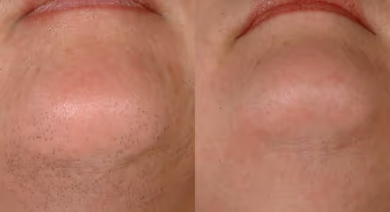 pcos laser hair removal before and after