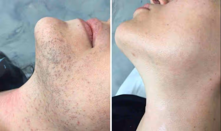pcos laser hair removal toronto