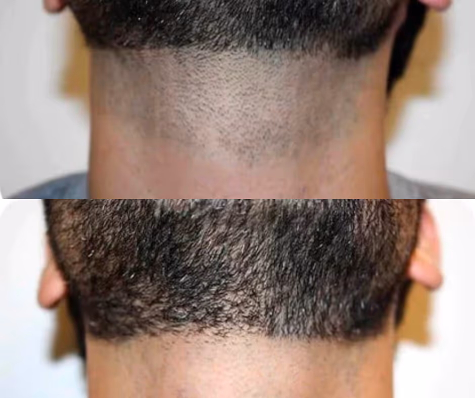 laser hair removal men before and after