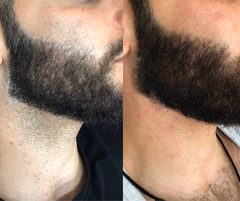 laser hair removal men before and after