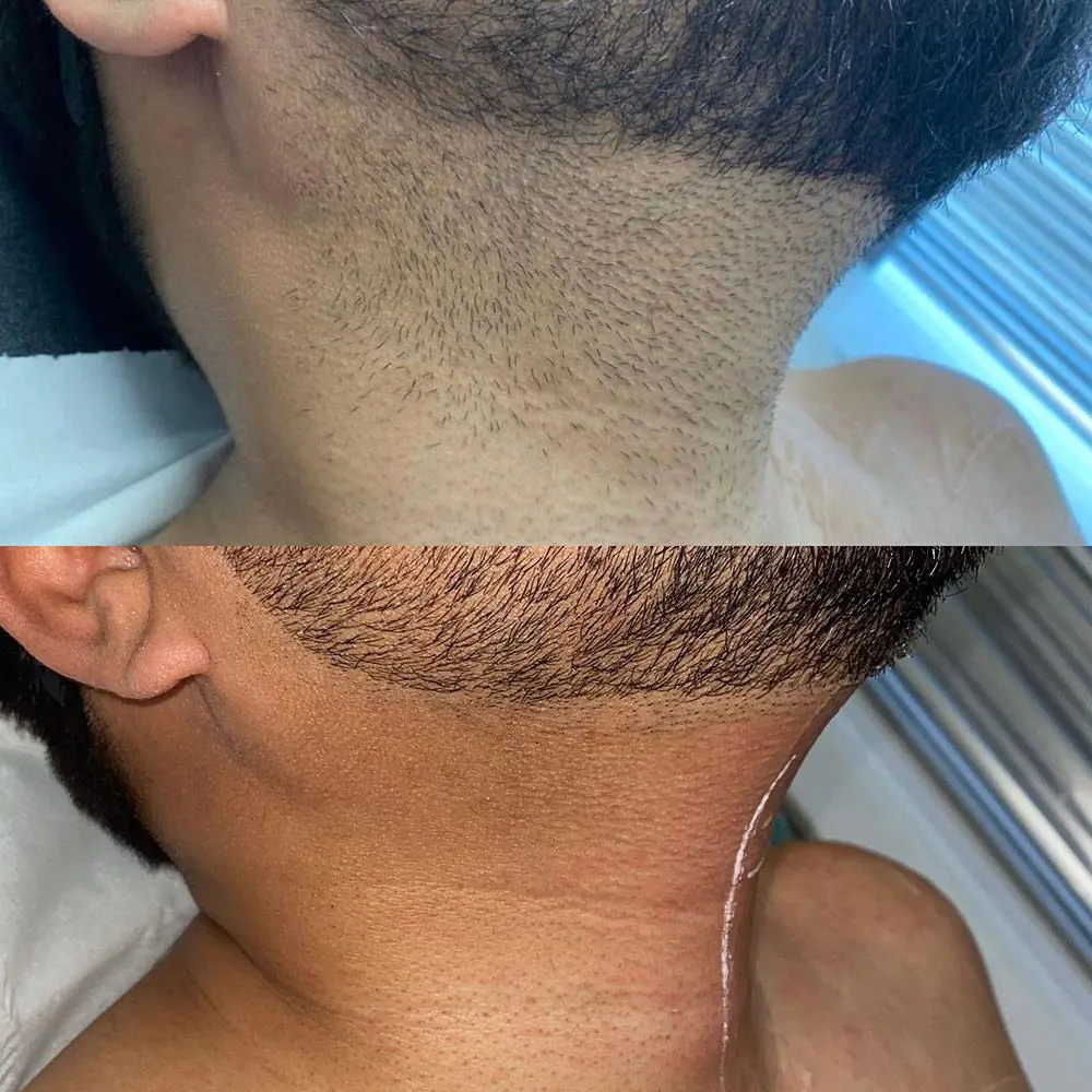 laser hair removal men before and after