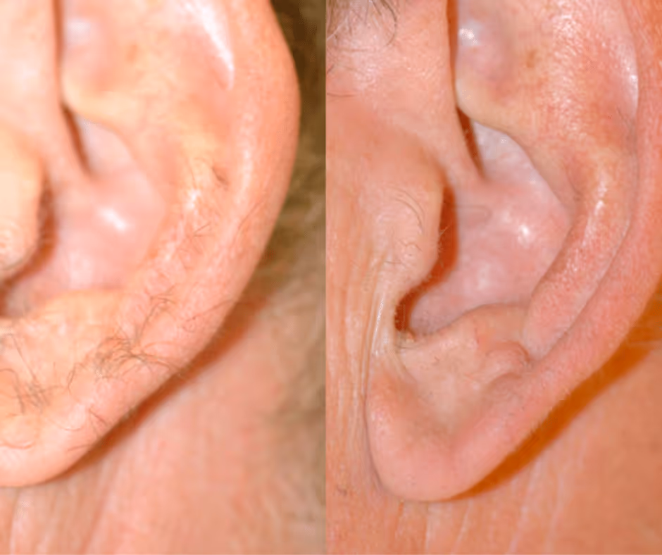laser hair removal for ear before and after