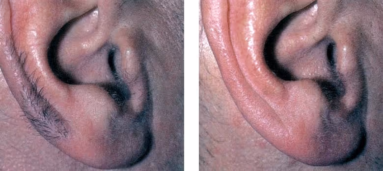 laser hair removal for ear before and after