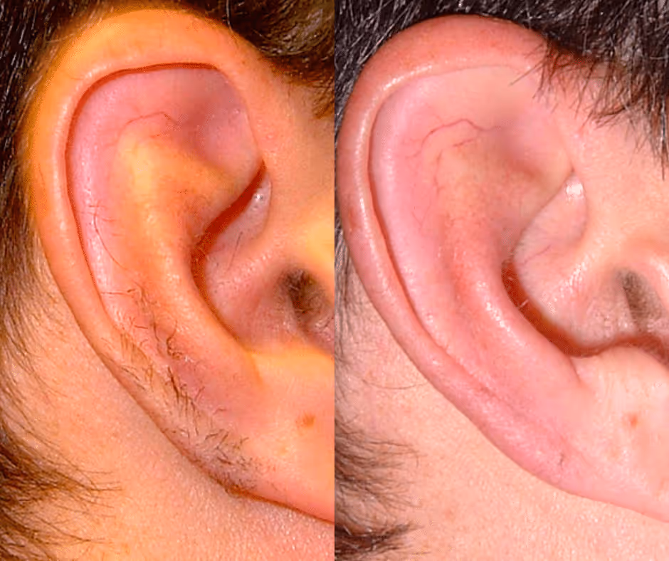 laser hair removal for ear before and after