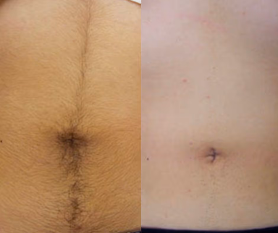 laser hair removal men before and after