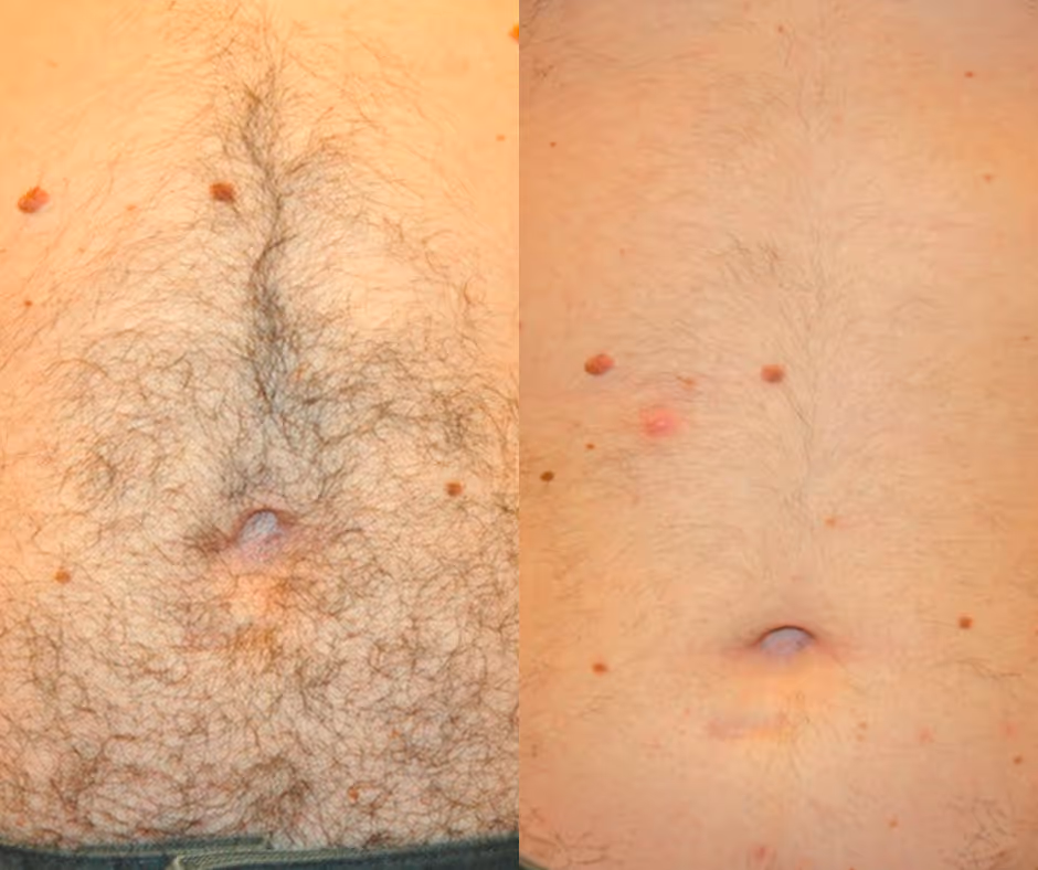 laser hair removal abdomen before and after