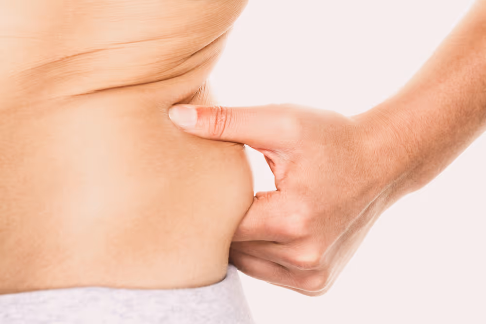 coolsculpting love handles toronto