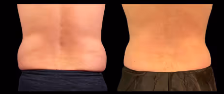 coolsculpting flanks before and after