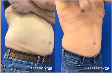 coolsculpting male breast before and after