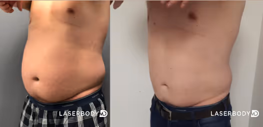 coolsculpting male breast before and after