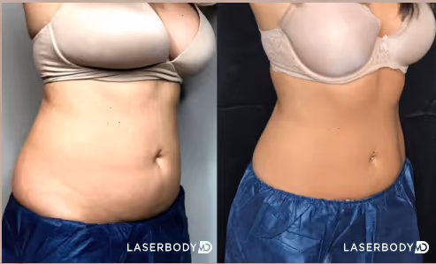 laser hair removal before and after