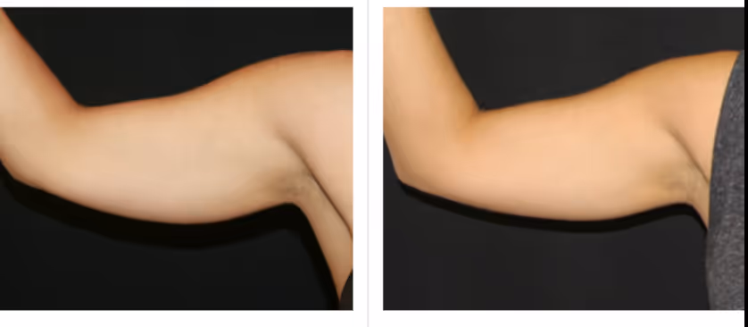 laser hair removal before and after