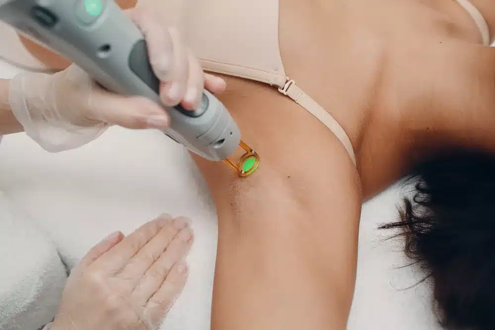 laser hair removal toronto