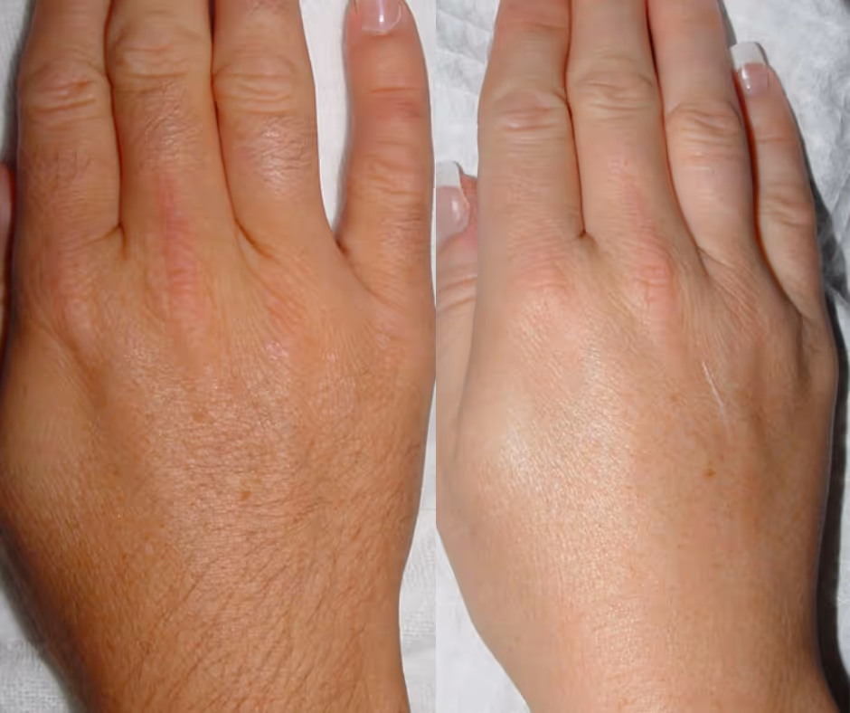 laser hair removal hands before and after