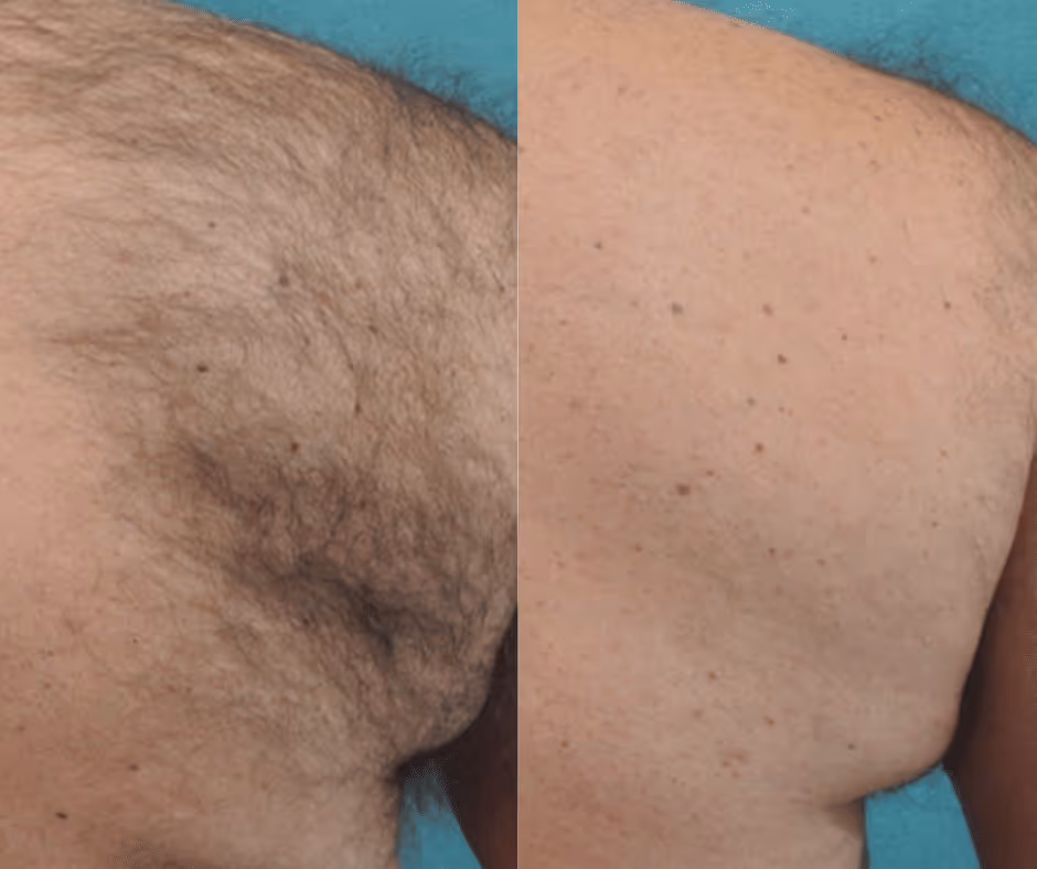 laser hair removal men before and after
