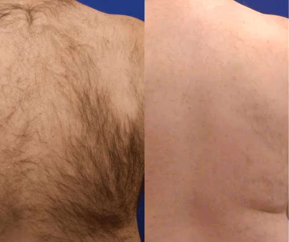 laser hair removal men before and after
