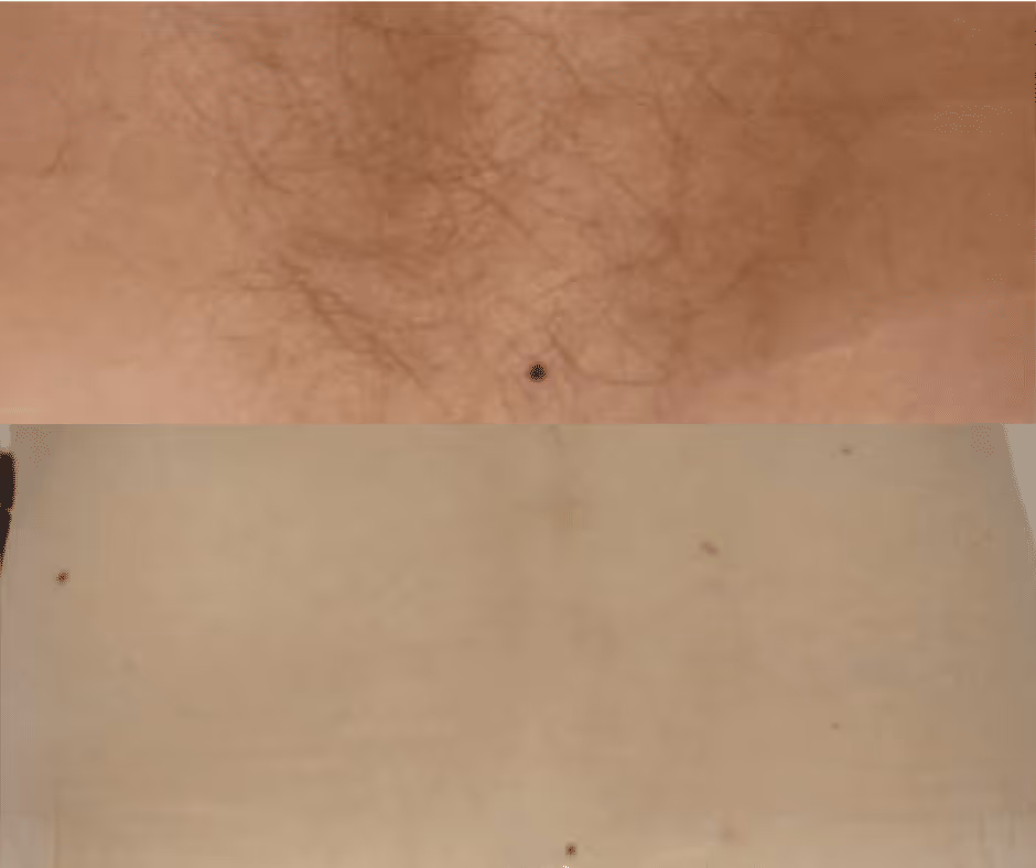 laser hair removal back before and after
