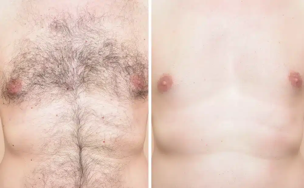 laser hair removal men before and after