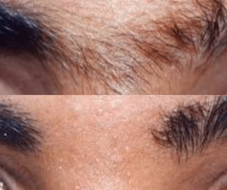 laser hair removal brow before and after