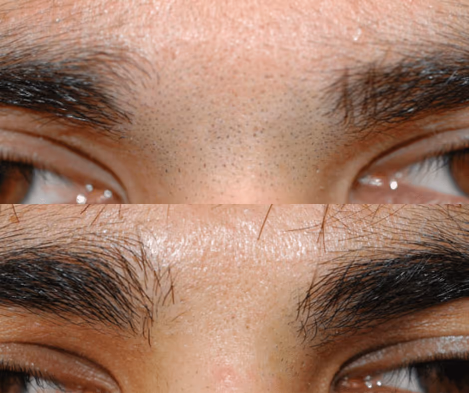 laser hair removal face before and after