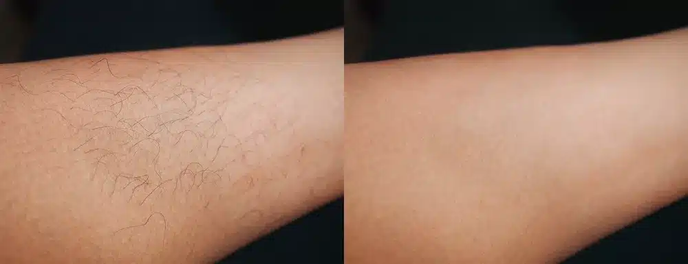 laser hair removal full body before and after