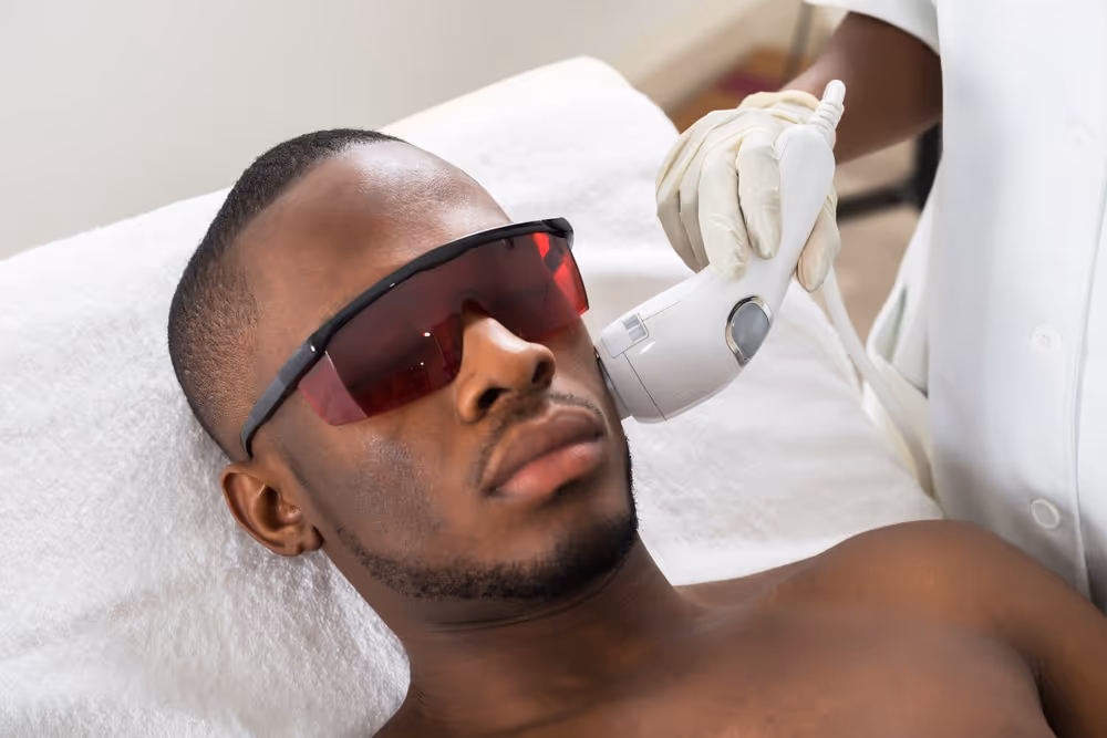 face laser hair removal for men