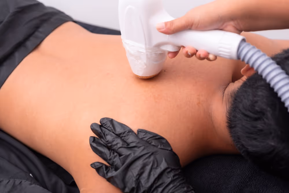 laser hair removal for back