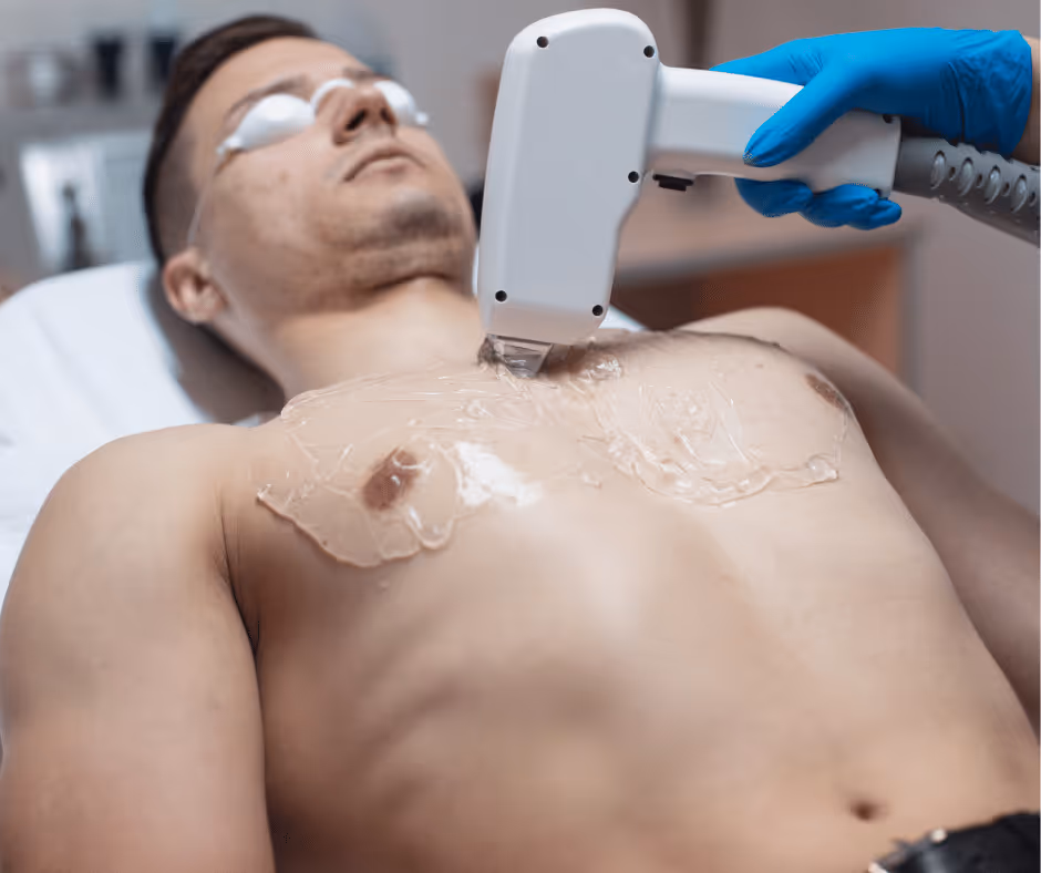 full body laser hair removal for men