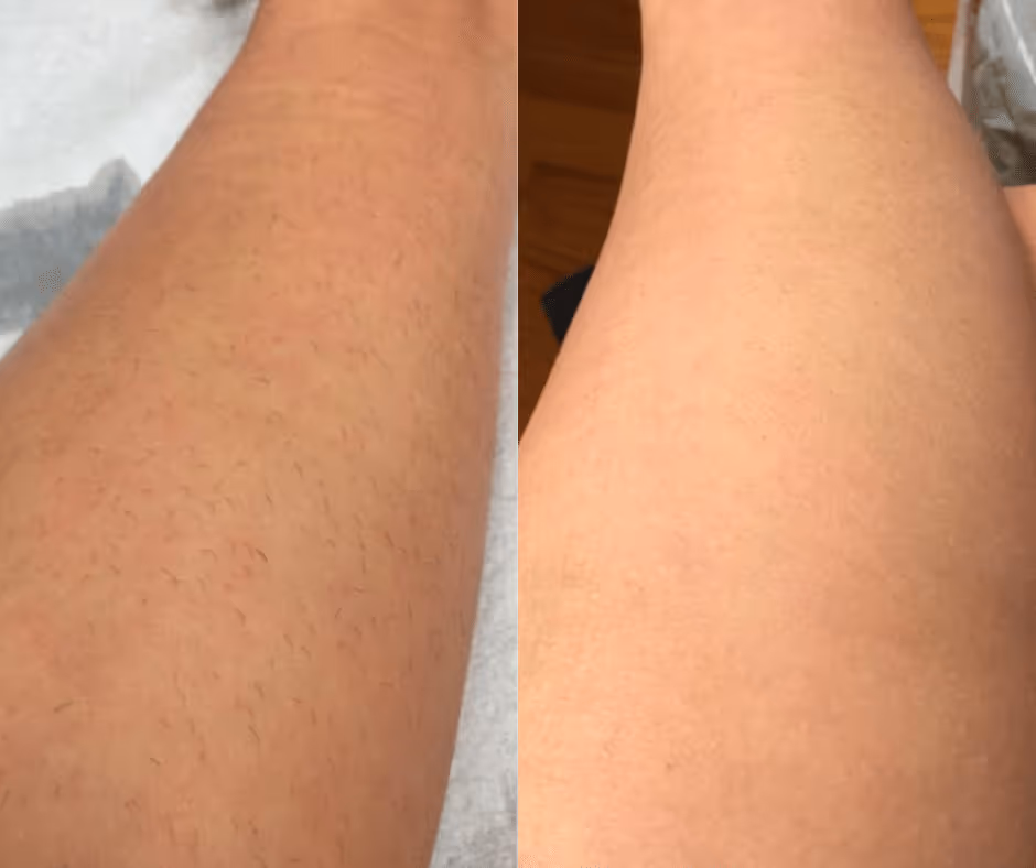 laser hair removal legs before and after