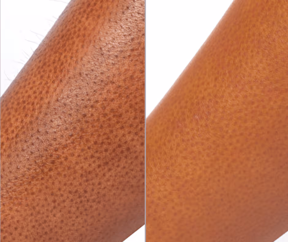 laser hair removal legs before and after