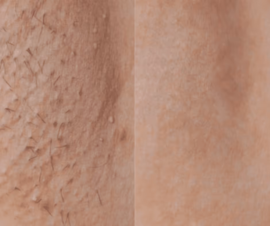 laser hair removal underarm before and after