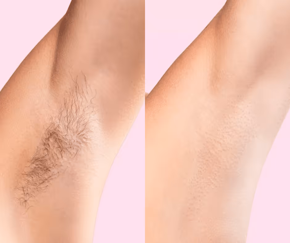 laser hair removal underarm before and after