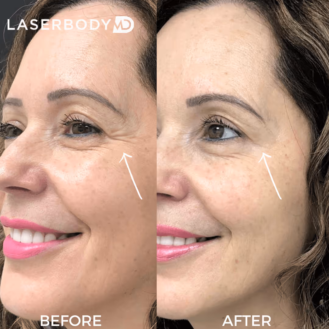 Botox before after