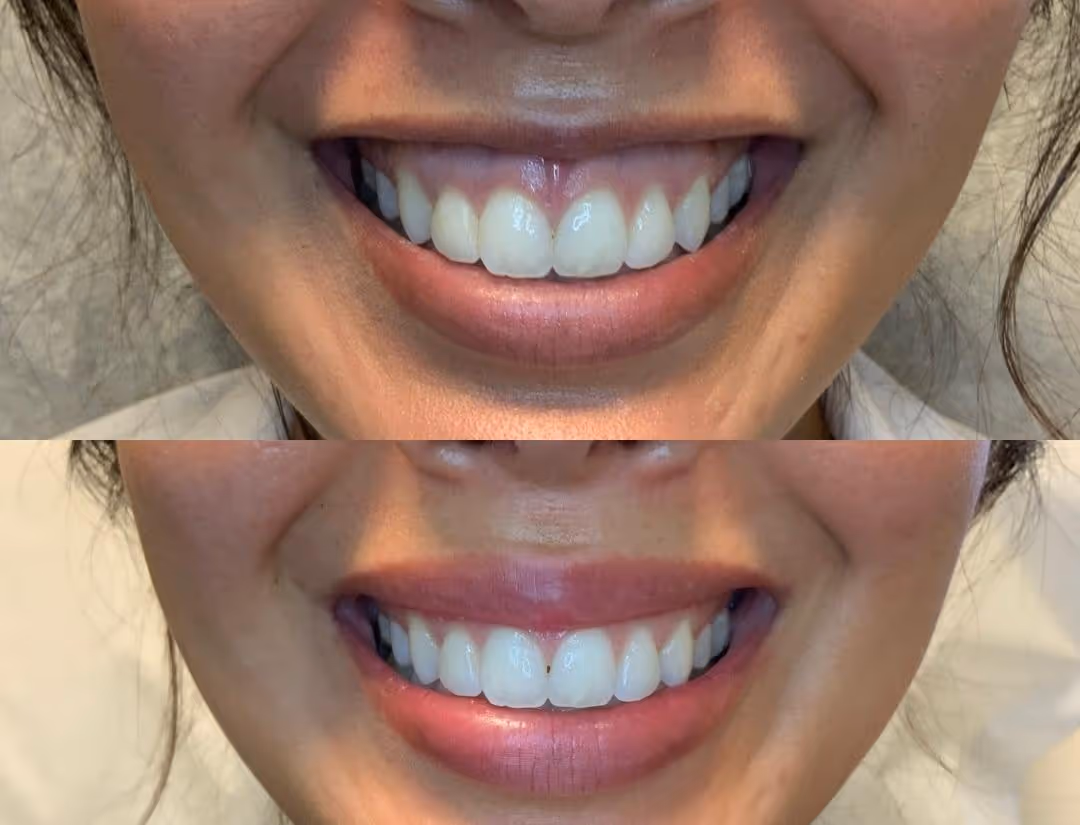 Before after lip augmentation