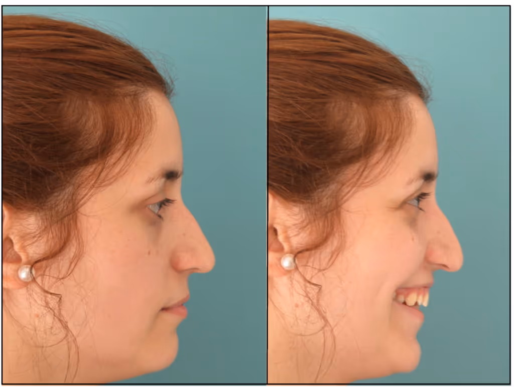 Nose before after botox