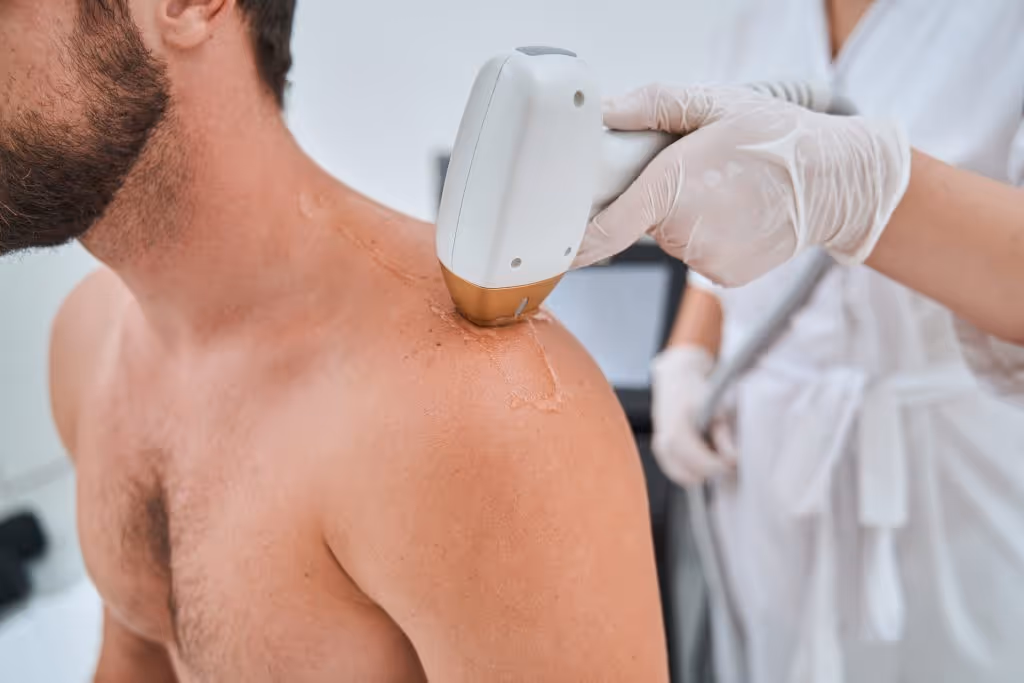 laser hair removal toronto