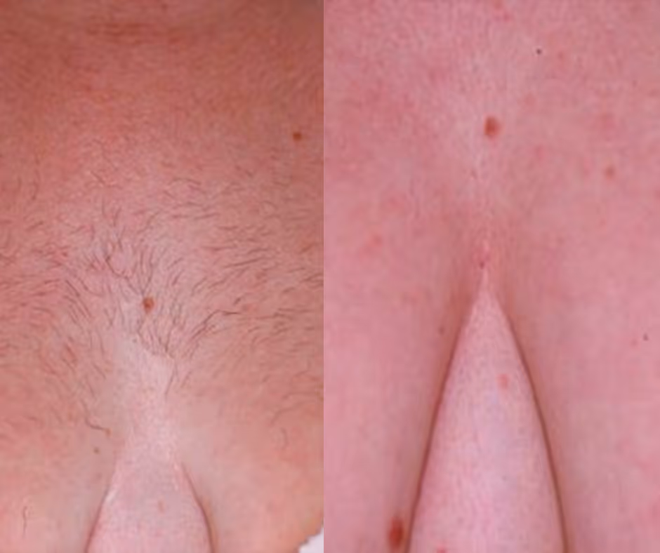 laser hair removal chest before and after