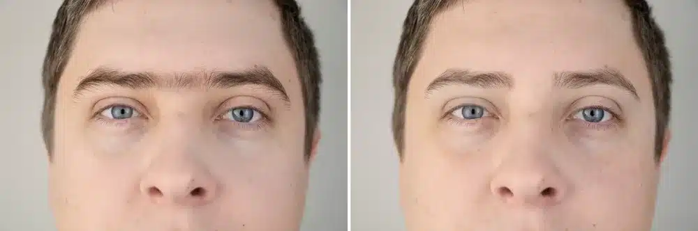 laser hair removal eyebrow before and after