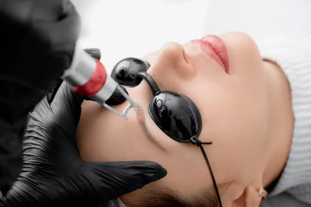 laser hair removal for eyebrows